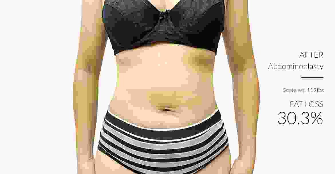 After-Abdominoplasty